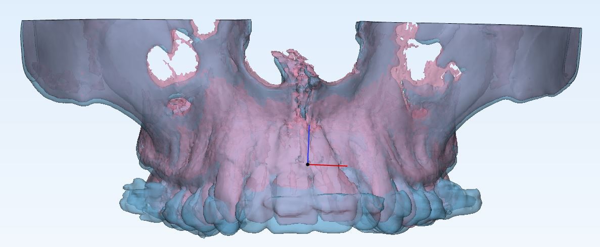 Jaw Volume Calculation